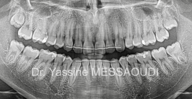 Canine incluse - Après traitement